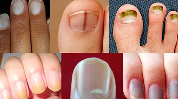 هشدار بیماری ها از روی رنگ ناخن