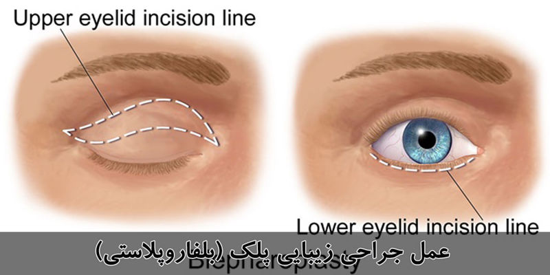 بلفاروپلاستی