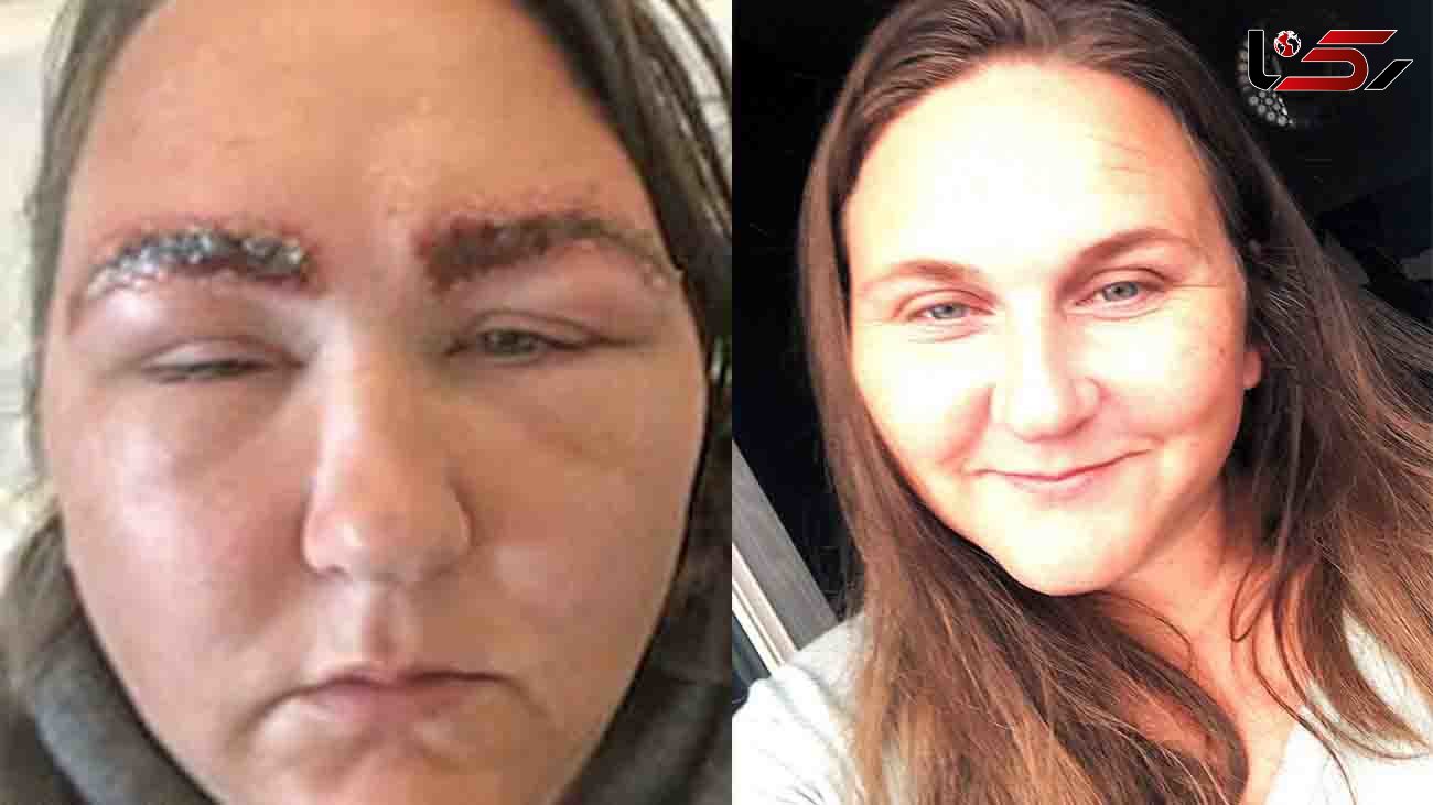 Woman, 34, claims she looked like a 'Space Raider alien' after an allergic reaction to salon dye caused her face to balloon in size and BURNED her eyebrows - and they took three months to grow back