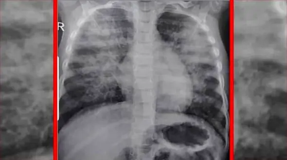 کودک 3 ساله که به دلیل کرونا در کمتر از 3 ساعت جان سپرد + عکس