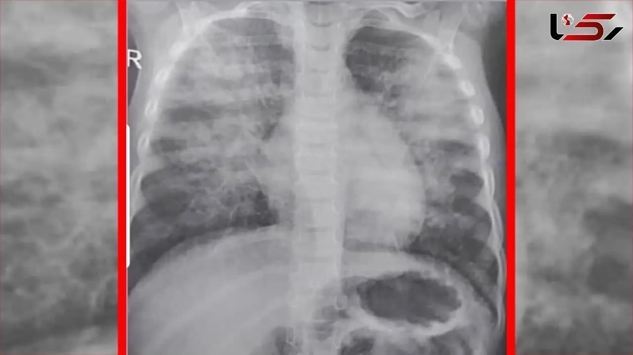 کودک 3 ساله که به دلیل کرونا در کمتر از 3 ساعت جان سپرد + عکس