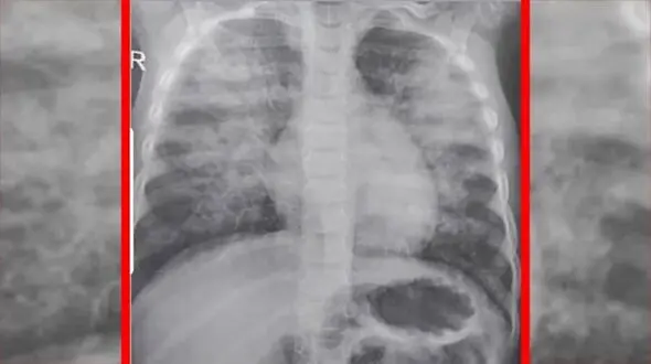 کودک 3 ساله که به دلیل کرونا در کمتر از 3 ساعت جان سپرد + عکس
