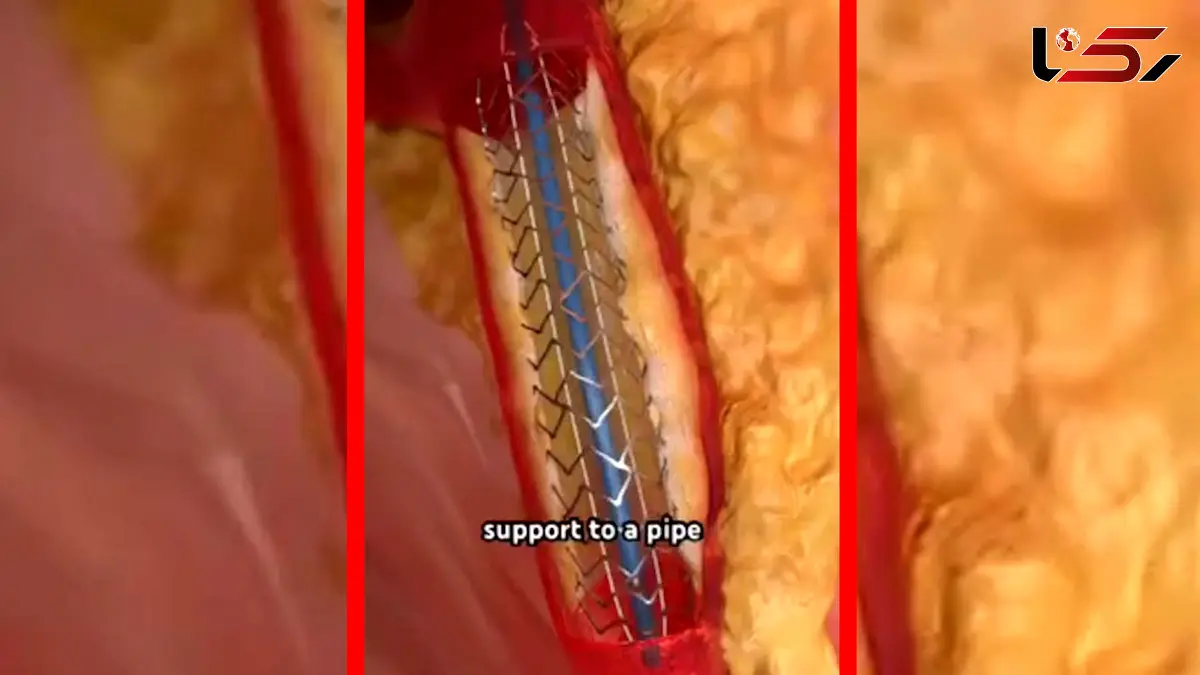 فیلم درمان سریع گرفتگی رگ قلب با ابزار الماسی