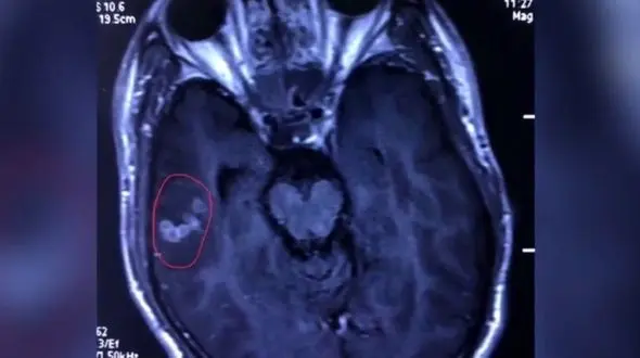 خارج کردن کرم 10 سانتیمتری از سر مرد چینی (روزنامه ایران)