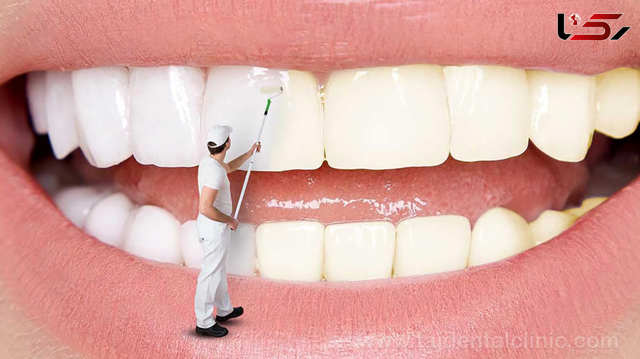 روش های آسان برای داشتن دندان سفید + فیلم 
