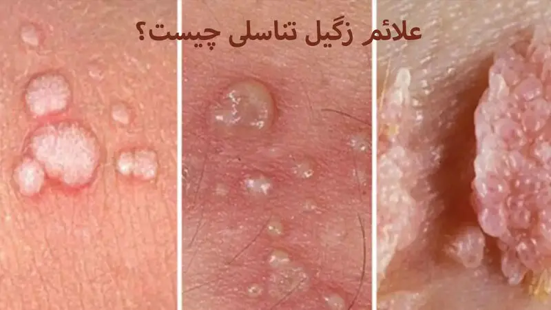 بیماری زگیل تناسلی در زنان