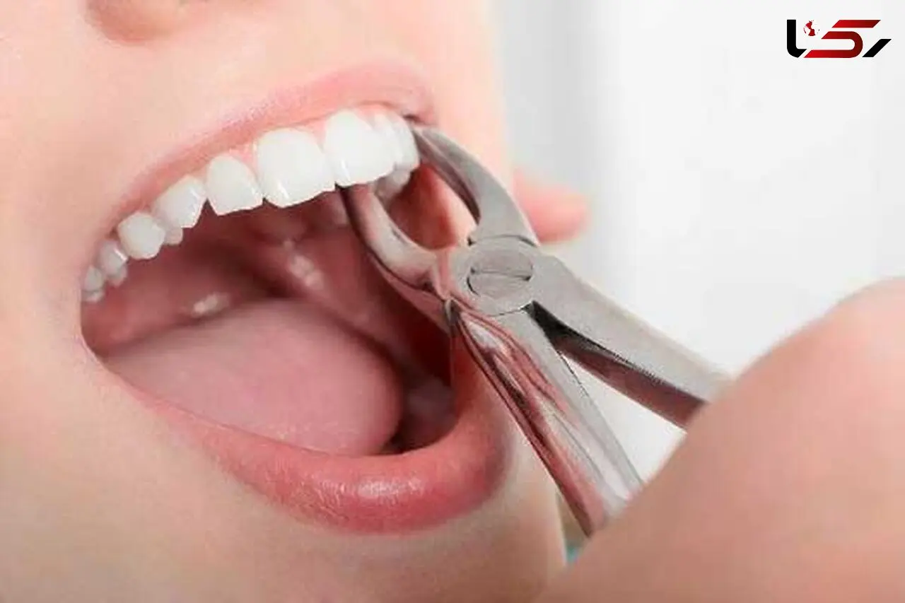 چرا باید دندان عقل را کشید؟