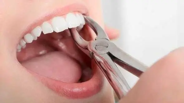 چرا باید دندان عقل را کشید؟