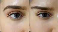 لیفت ابرو نیمه دائم چیست؟ مزایا و معایب