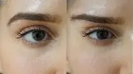 لیفت ابرو نیمه دائم چیست؟ مزایا و معایب