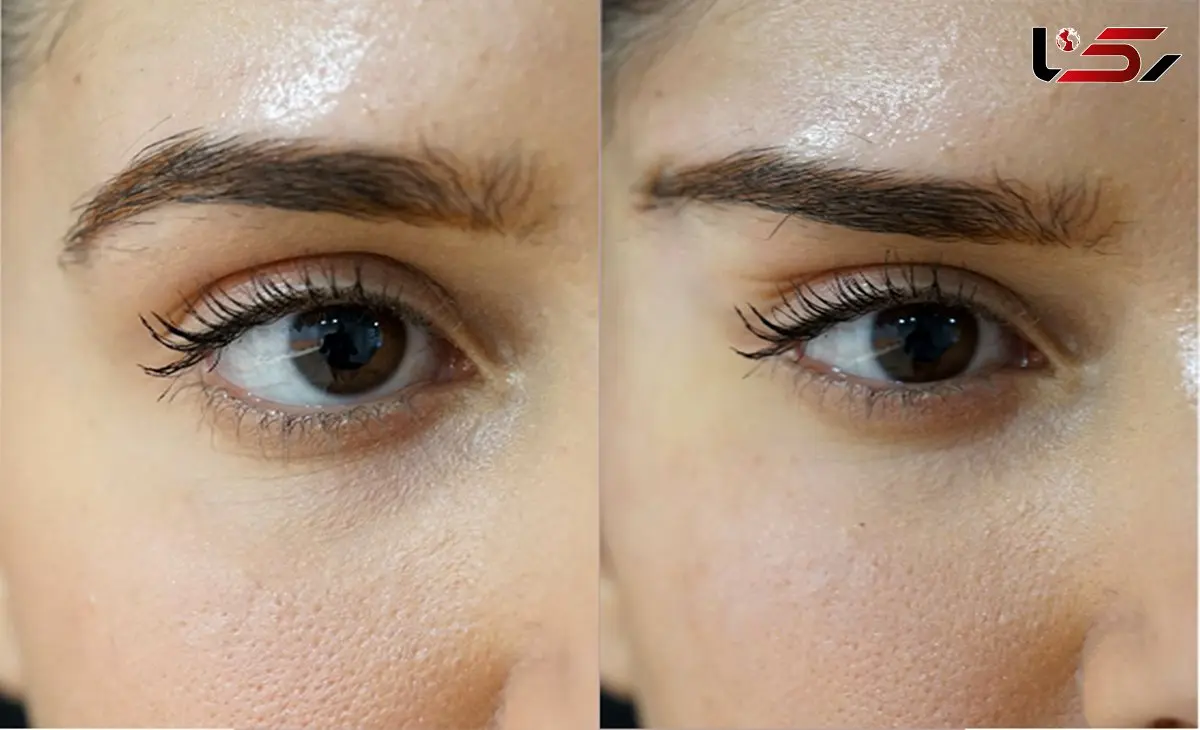 لیفت ابرو نیمه دائم چیست؟ مزایا و معایب