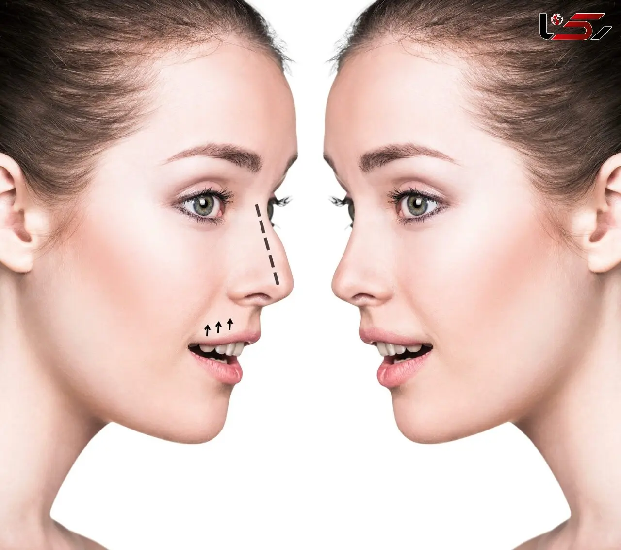 مراحل جراحی بینی از تصمیم گیری قبل از عمل تا روز جراحی