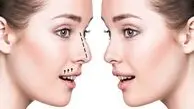 مراحل جراحی بینی از تصمیم گیری قبل از عمل تا روز جراحی
