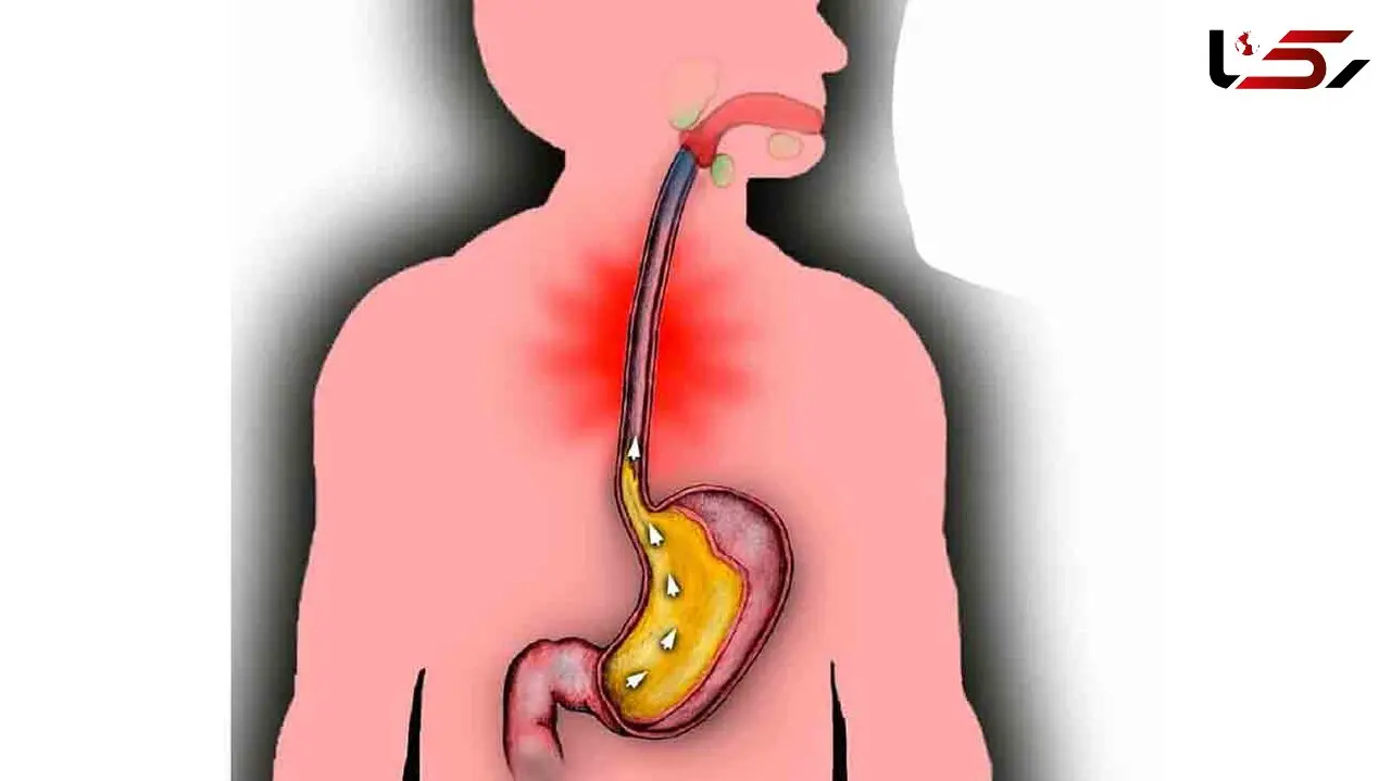 رفلاکس معده چه بلایی سر فرد می آورد؟
