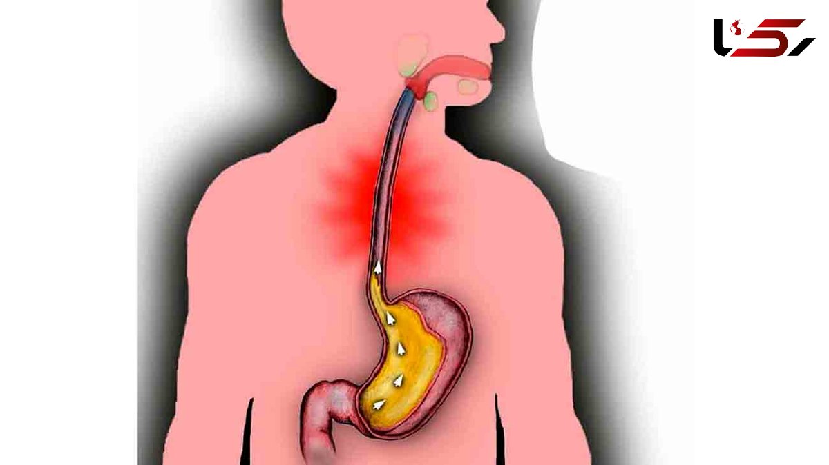 رفلاکس معده چه بلایی سر فرد می آورد؟