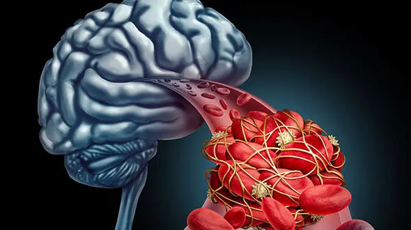 انواع سکته مغزی و راه های درمانی 