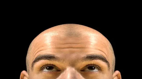 این علامت مهم در سر آقایان نشانه سرطان است 