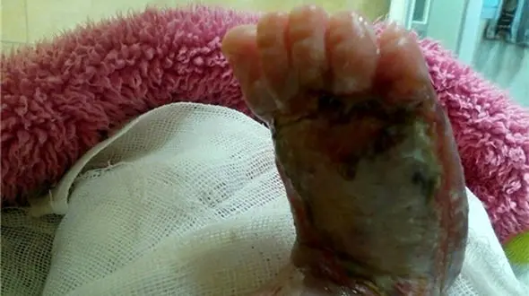 سوختگی پای نوزاد 6 روزه با تزریق اشتباه در بیمارستان دولتی+تصاویر