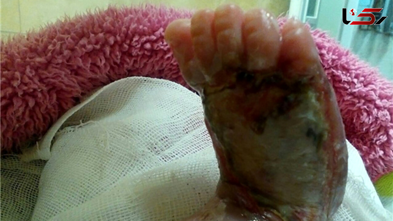 سوختگی پای نوزاد 6 روزه با تزریق اشتباه در بیمارستان دولتی+تصاویر
