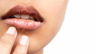 بررسی دلایل خشکی دهان