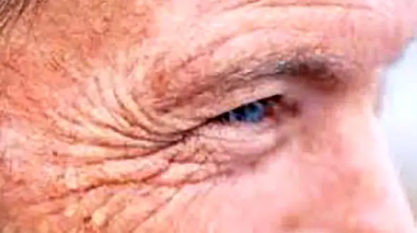 چین و چروک‌های دور چشم را محو کنید + راهکارهای موثر