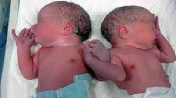 تولد عجیب ترین دو قلو عاشق + عکس