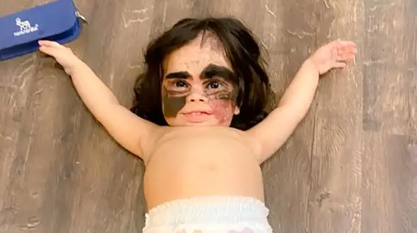 دختر بتمن زیر تیغ جراحی رفت + عکس