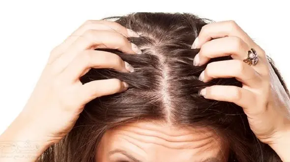 درمان جوش کف سر با راهکارهای طبیعی