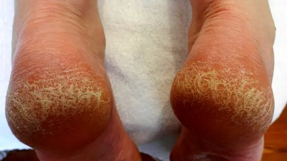 ترک پا زنگ هشدار ابتلا به این بیماری های پوستی