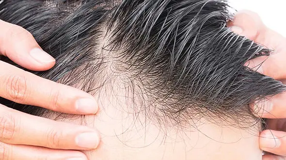 ماه جهانی آگاهی از ریزش مو؛ وقتی موها زنگ خطر خاموش بدن می شوند ! + فیلم