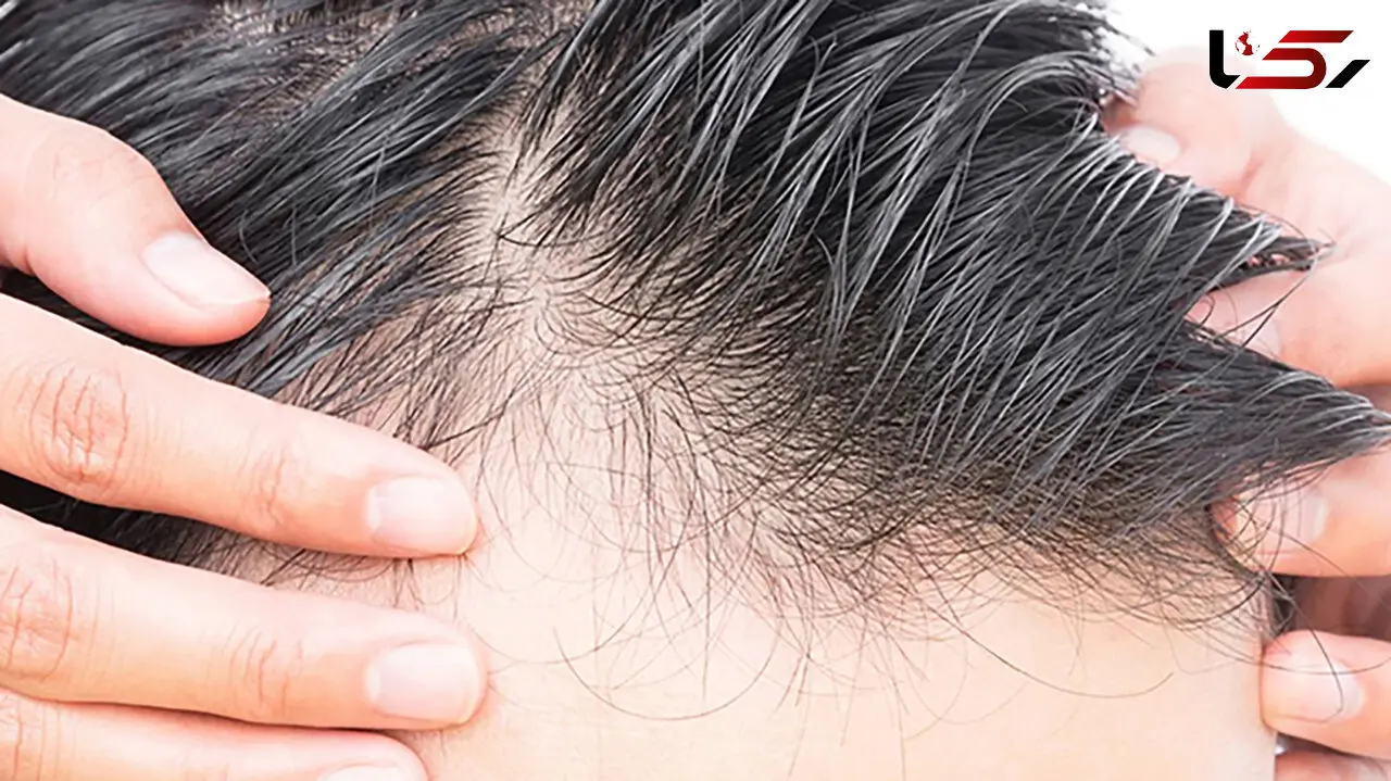 ماه جهانی آگاهی از ریزش مو؛ وقتی موها زنگ خطر خاموش بدن می شوند ! + فیلم