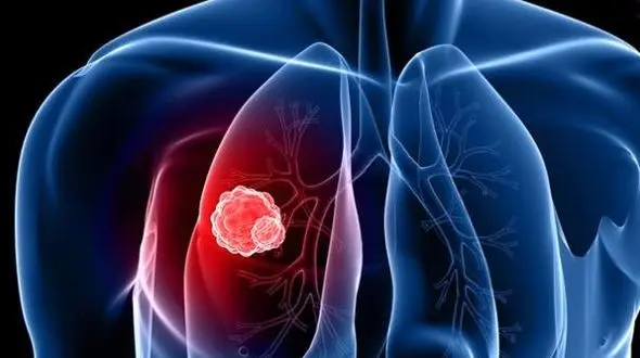 محاسبه ریسک ابتلا به سرطان ریه با یک ابزار آنلاین