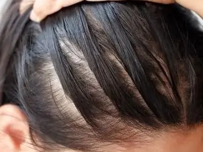 استرس و ریزش مو؛ یک حقیقت تلخ که باید بدانید