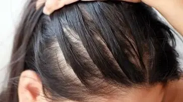 استرس و ریزش مو؛ یک حقیقت تلخ که باید بدانید