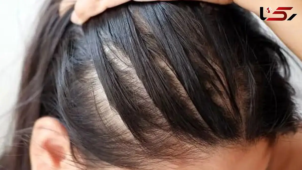 استرس و ریزش مو؛ یک حقیقت تلخ که باید بدانید