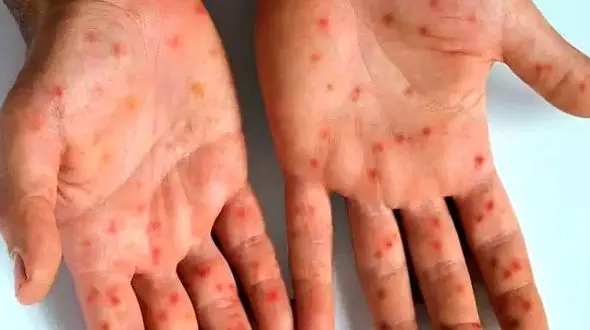 مینو محرز: احتمال ورود آبله میمون به ایران وجود دارد 