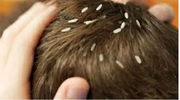 آنچه در مورد شپش باید بدانیم