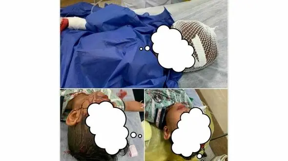 سگ هار پوست سر کودک 7 ساله بندرعباسی را کند !+ عکس