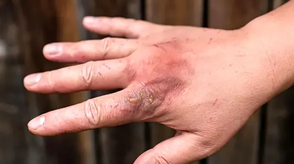 هشدار جدی دانشگاه علوم پزشکی هرمزگان درباره افزایش موارد گزش در فصل گرما / ثبت بیش از ۱۳۰۰ مورد عقرب گزیدگی و ۱۶۰ مورد مارگزیدگی در استان