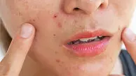 نسخه طب سنتی برای حساسیت پوستی