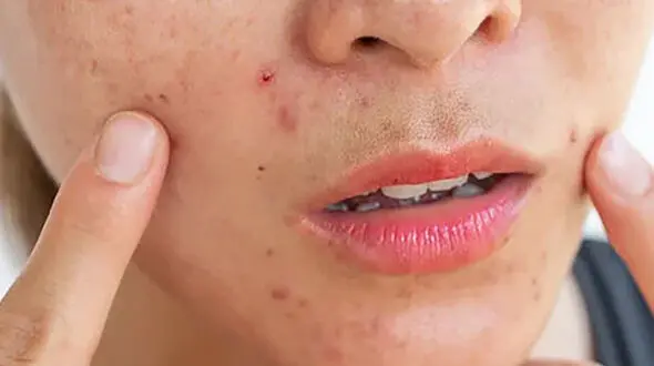 نسخه طب سنتی برای حساسیت پوستی