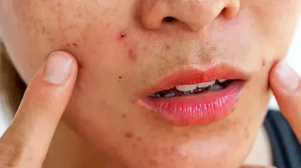 نسخه طب سنتی برای حساسیت پوستی