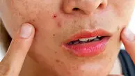نسخه طب سنتی برای حساسیت پوستی