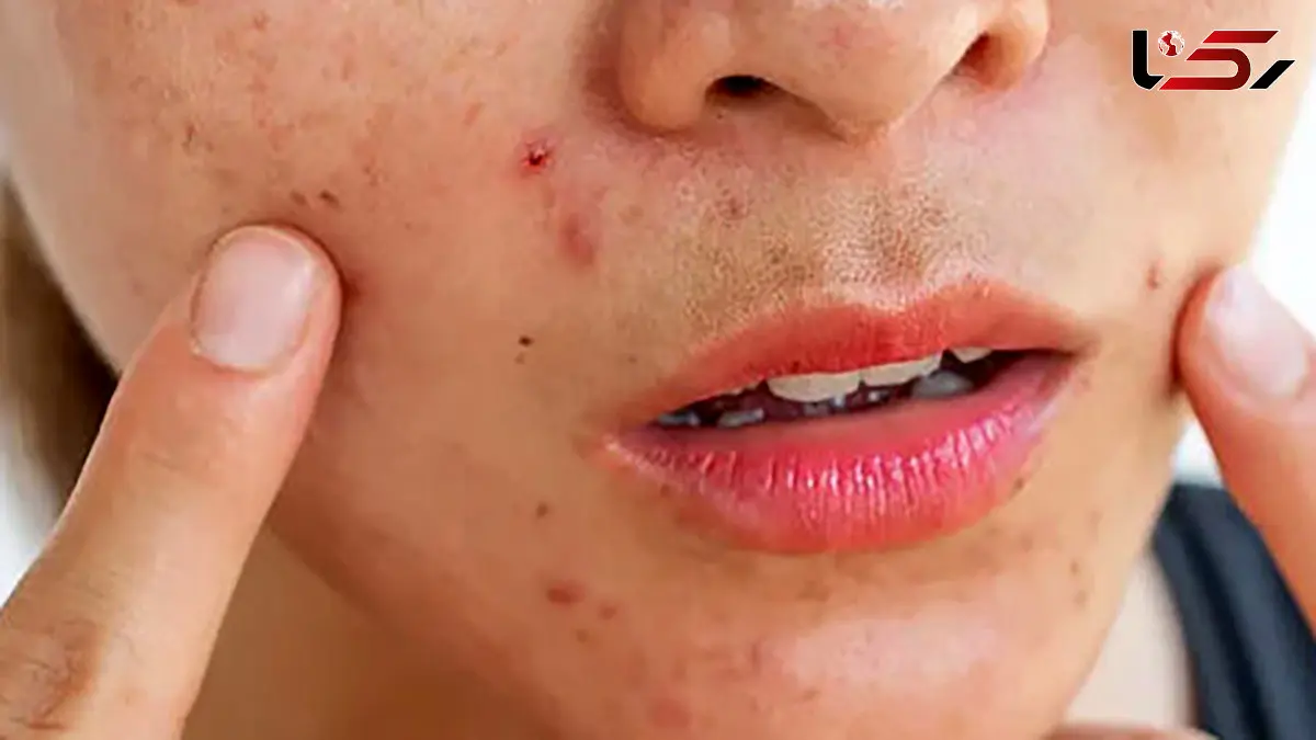 نسخه طب سنتی برای حساسیت پوستی