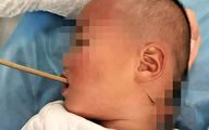 Boy survives after having an eight-inch chopstick stuck in his throat