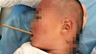Boy survives after having an eight-inch chopstick stuck in his throat