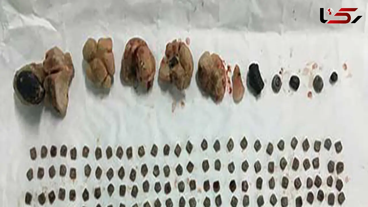 خروج بیش از ۱۵۰ تکه سنگ از کلیه یک بیمار + تصویر 