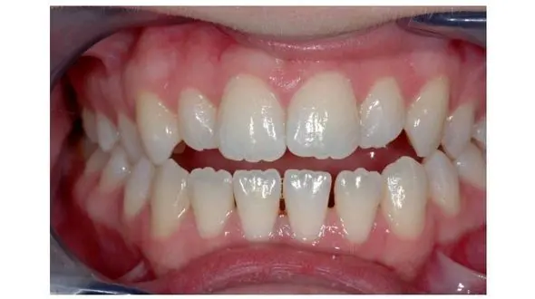 چرا دندان هایمان دندانه دار می شوند؟!