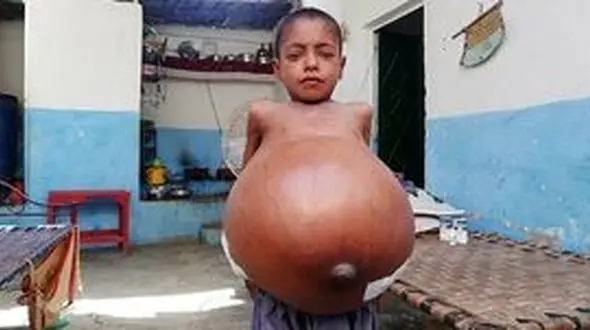 راز مخوف شکم برآمده  پسر ۹ ساله چیست؟! + عکس باورنکردنی 