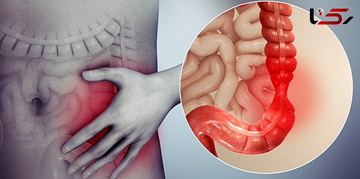  سندروم روده تحریک پذیر چیست؟ 